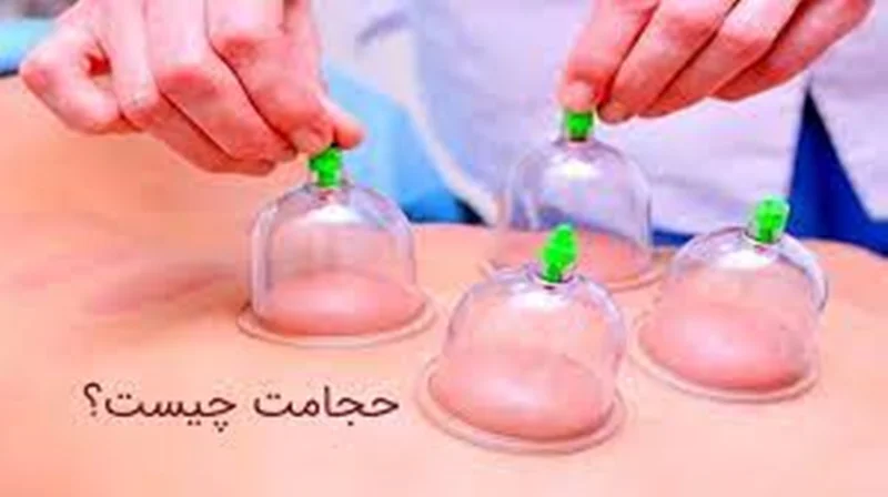 حجامت چیست و انواع آن