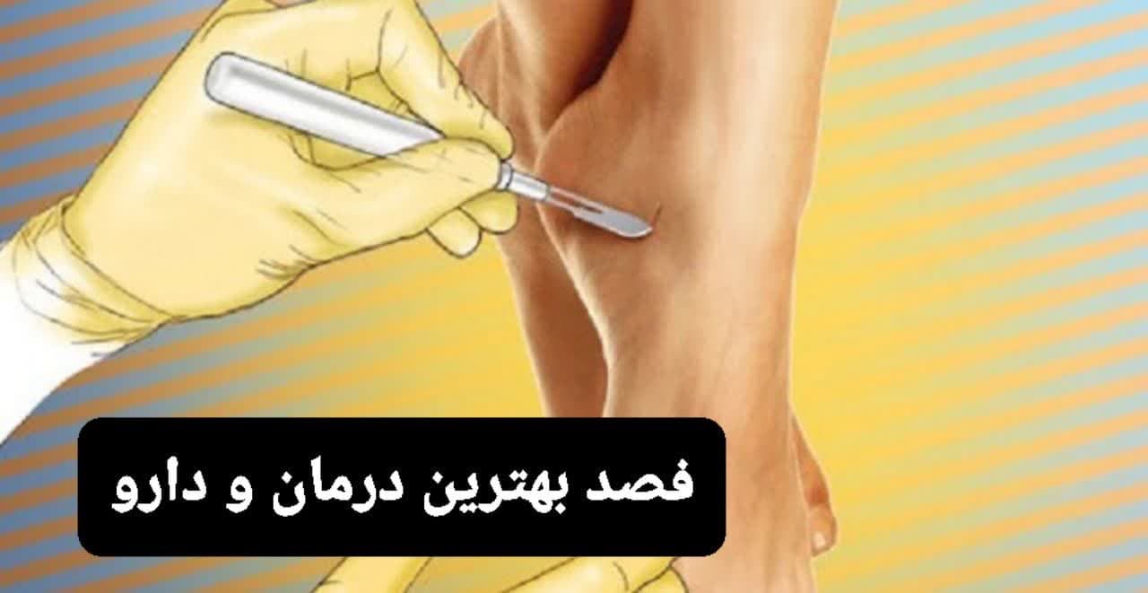 فصد بهترین درمان و دارو است