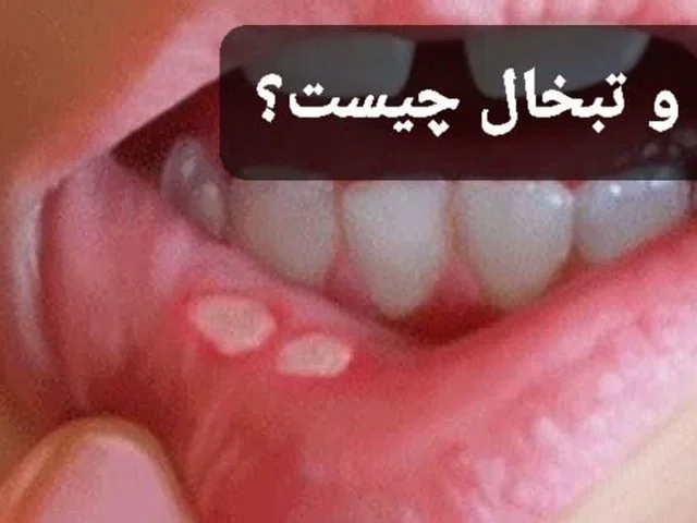 دلیل آفت و تبخال چیست ؟